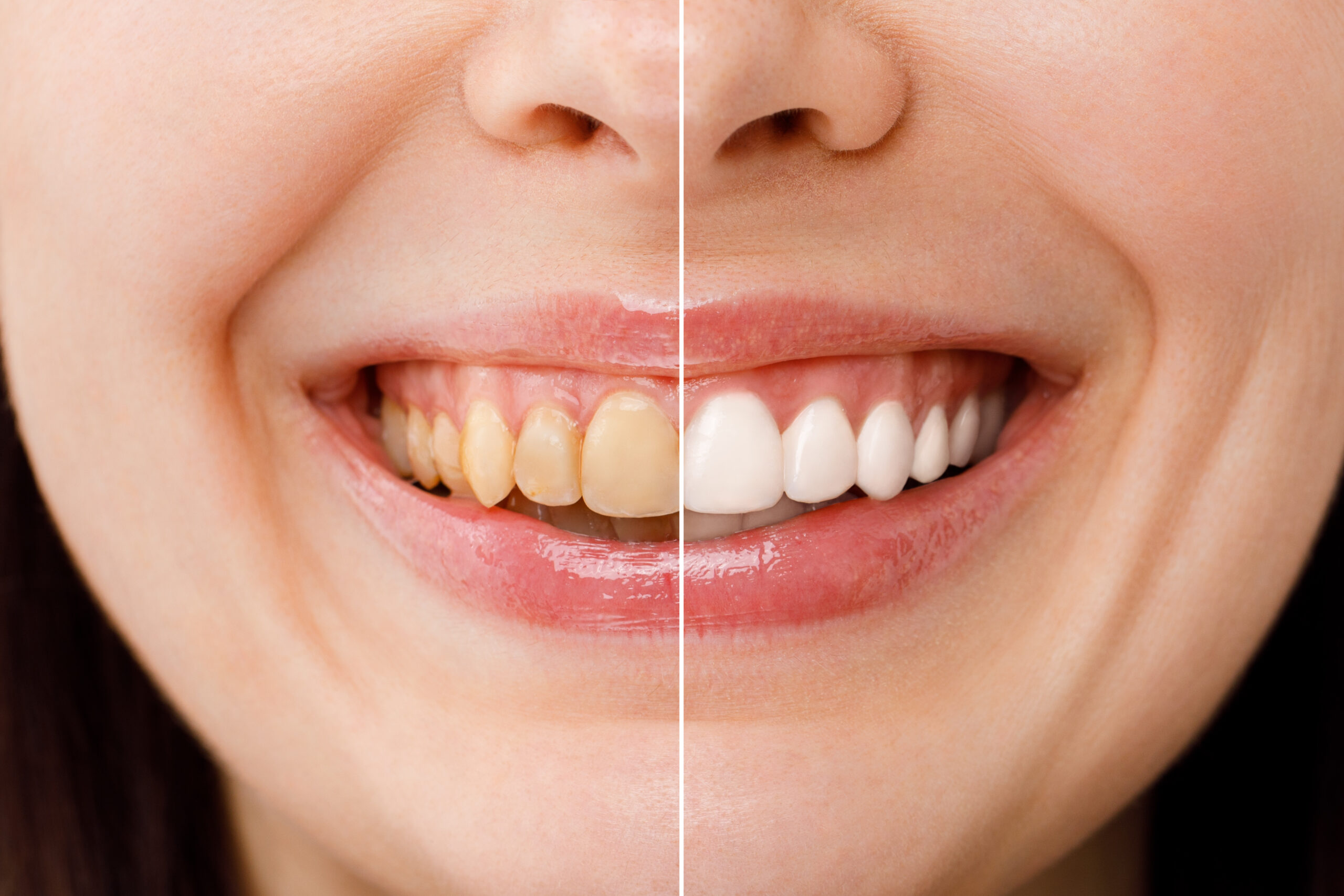 woman teeth before and after whitening. Over white background. Dental clinic patient. Image symbolizes oral care dentistry, stomatology